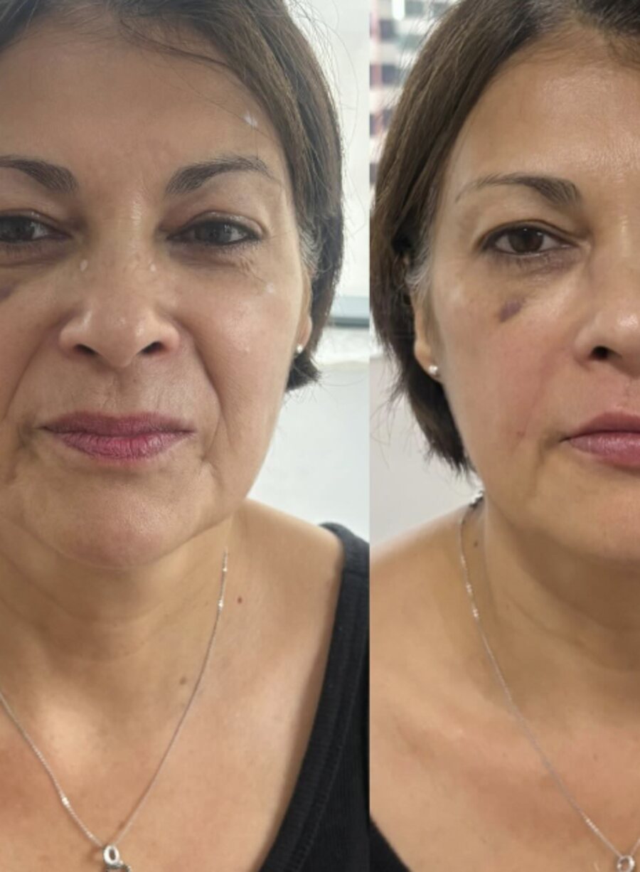 Harmonização Facial