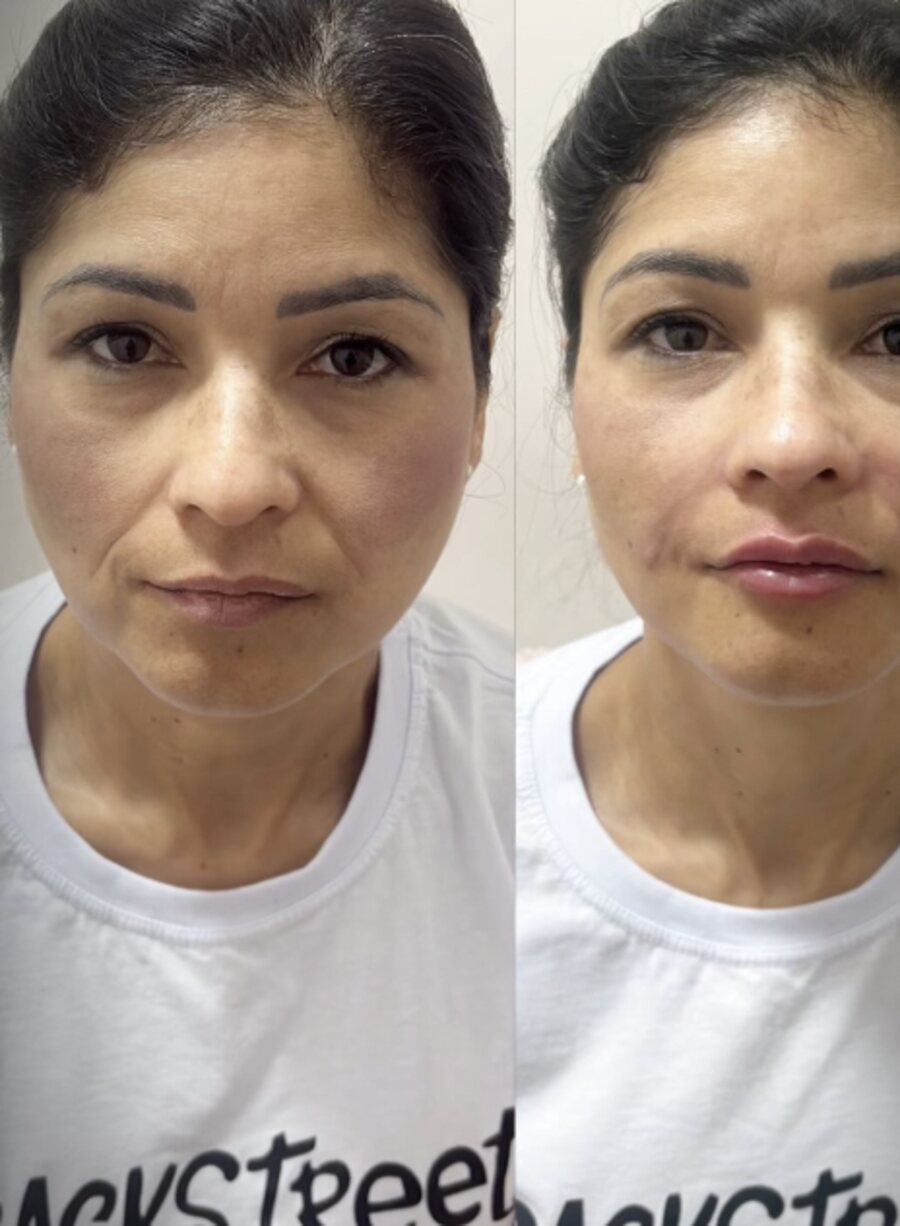 Full face, antes e depois