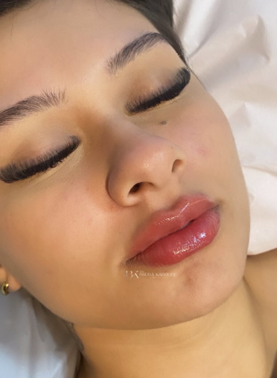 Contorno labial, resultado