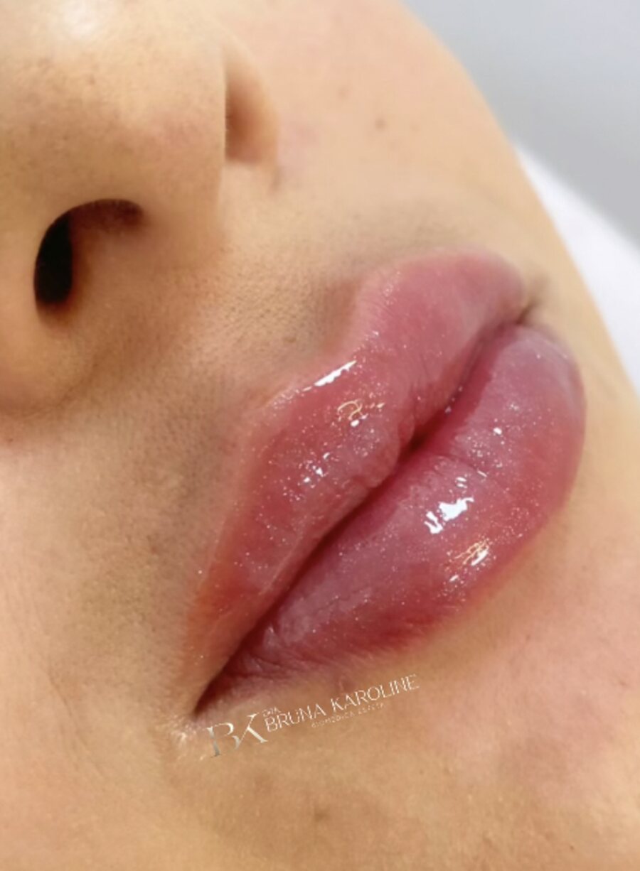 Skinbooster, resultado de paciente