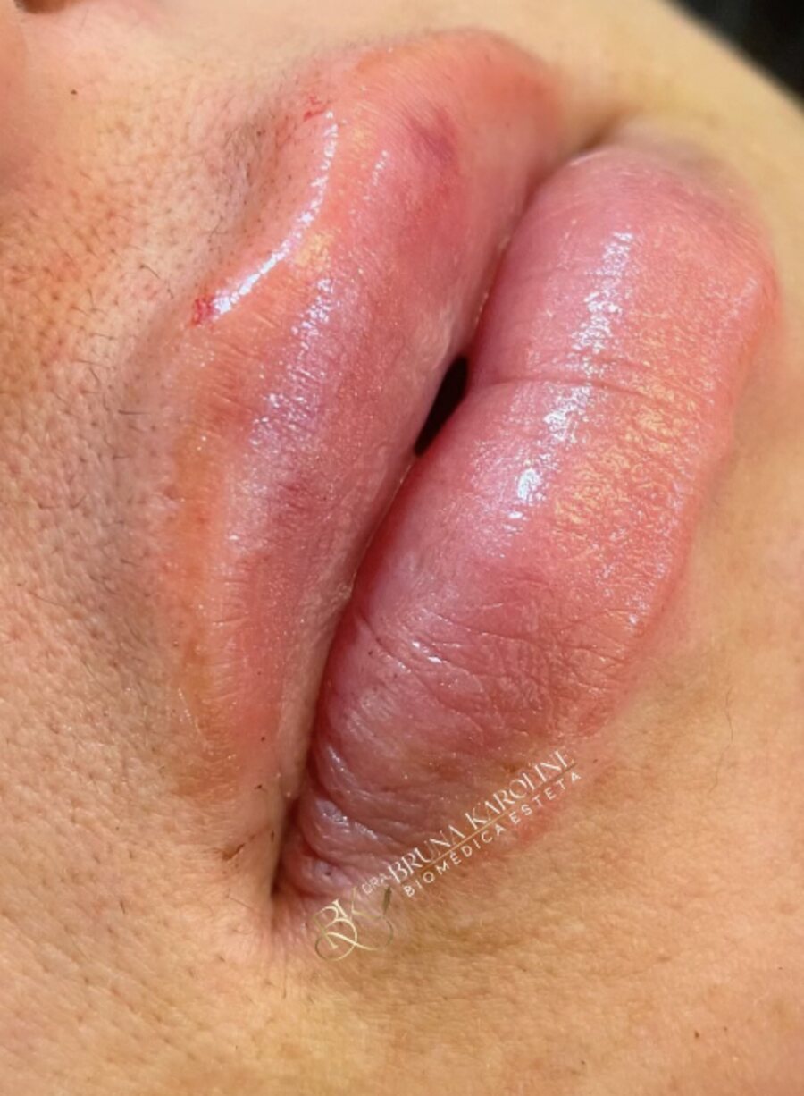 Preenchimento Labial
