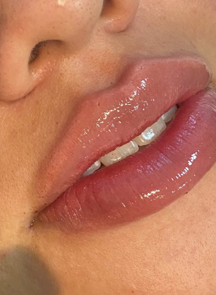 Volume labial, resultado