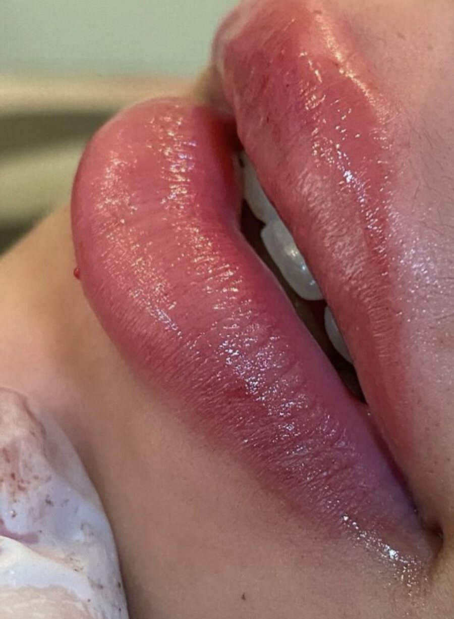 Definição do contorno labial